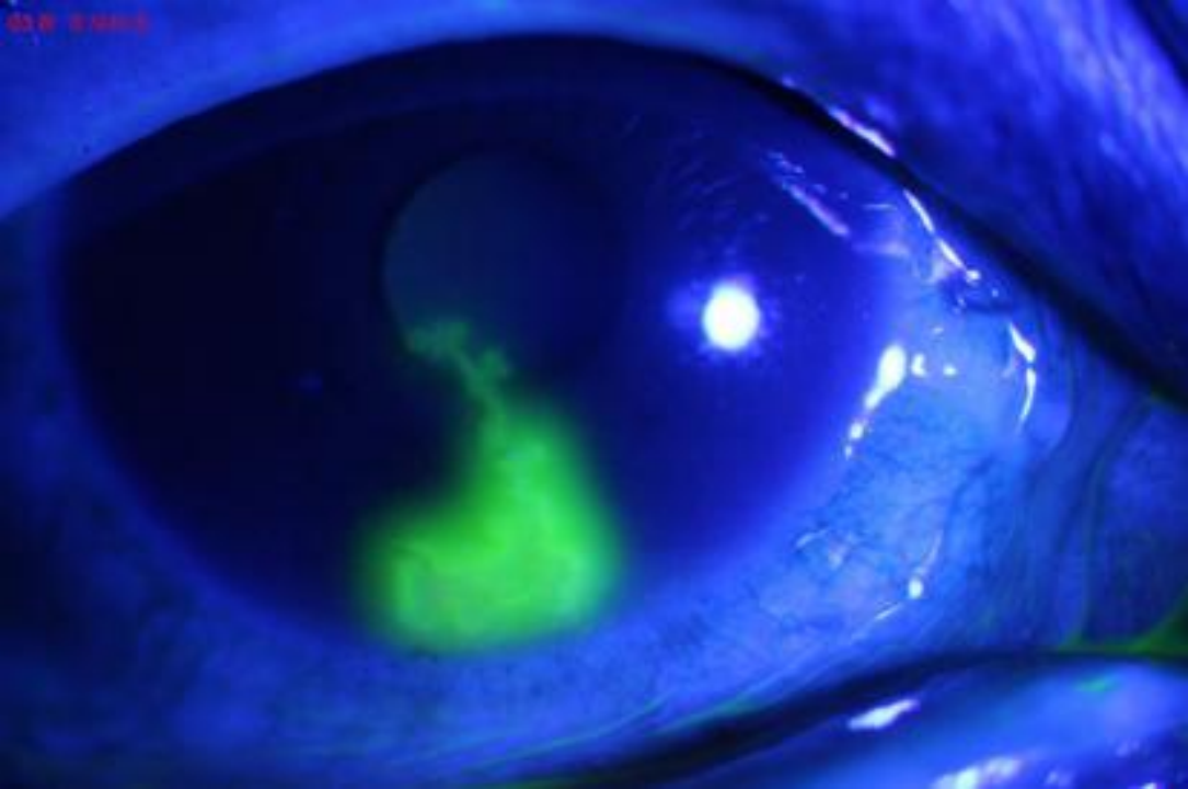 新冠病毒很可能存在眼部趋向性