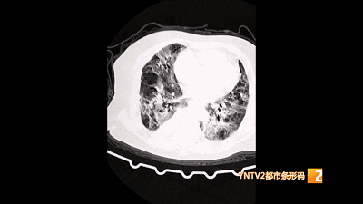 3类人群新冠感染后需做肺部CT